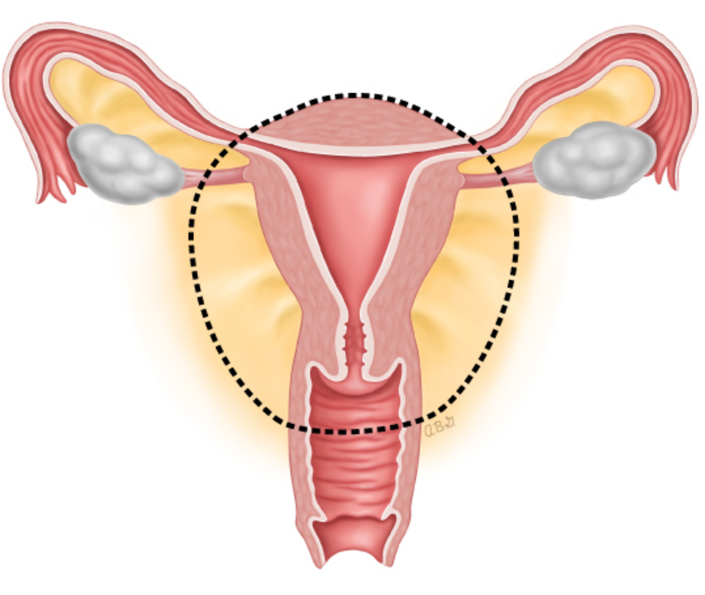 هیسترکتومی 